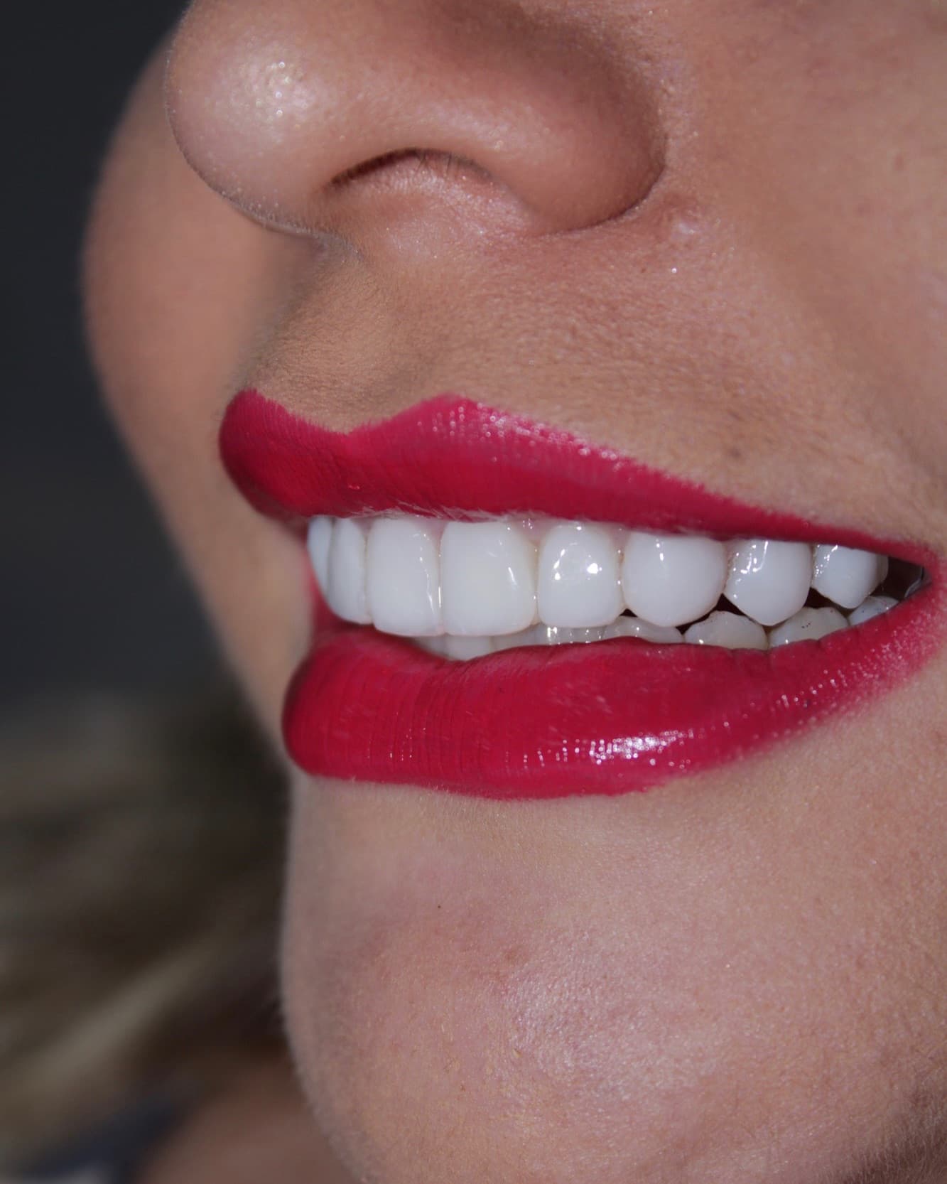 Después - Blanqueamiento Dental