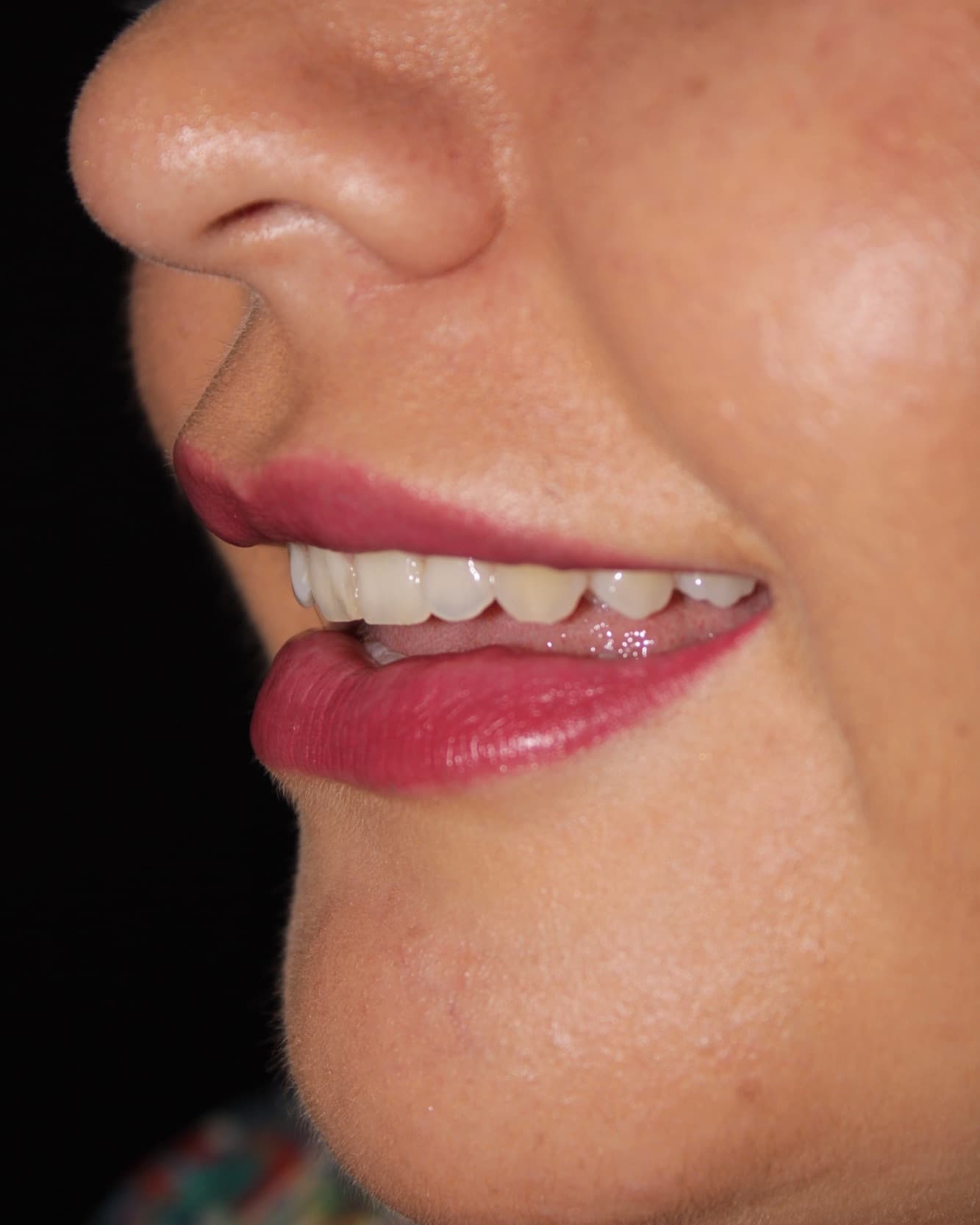 Antes - Blanqueamiento Dental